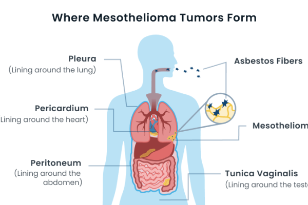 Mesothelioma